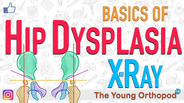 Developmental Dysplasia of Hip, DDH X Ray features, NEET PG, USMLE, Dysplastic hip, CDH