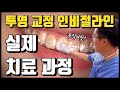투명 교정 인비절라인 효과? 실제 '교정 과정' 공개 (feat.치위생사 사비로 도전)