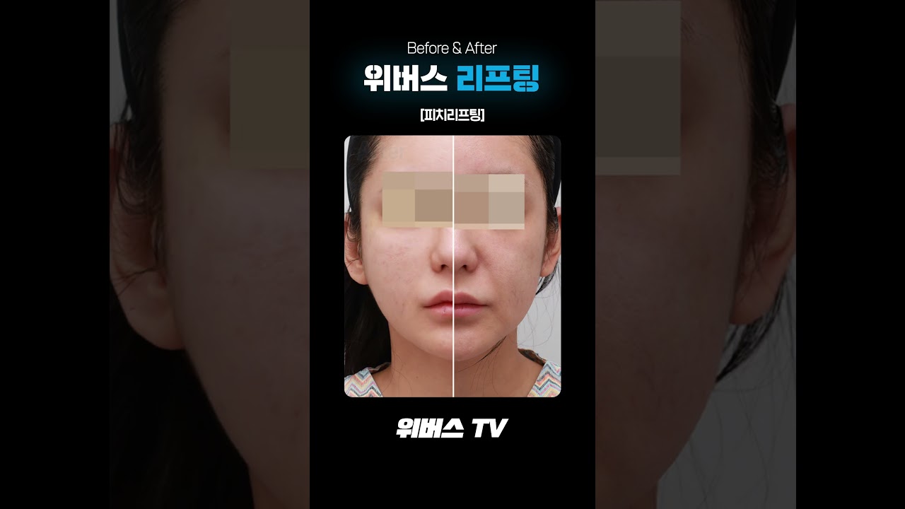 [Вэвэрс гоо сайхны мэс заслын клиник] Утас лифтингийн үндэс 👍Тоор лифтинг👍