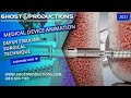 Depuy fibulink surgical technique  ankle fracture repair ghost productions medical animaton