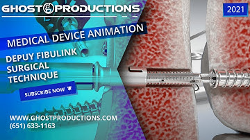 DePuy FibuLINK Surgical Technique - Ankle Fracture Repair. Ghost Productions Medical Animaton
