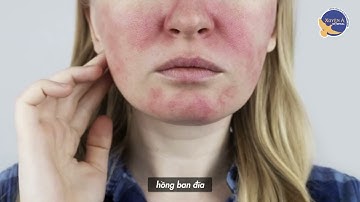BVXA HCM - TÌM HIỂU BỆNH LUPUS BAN ĐỎ HỆ THỐNG
