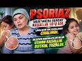 PSORIAZ: URUG‘IMIZDA BUNDAY KASALLIK YO‘Q EDI… QIZIMDA PAYDO BO‘LDI | BELEEVER