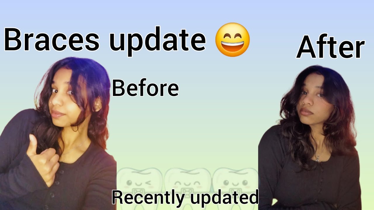 😔Recently updated ll braces update before and after part 1 #braces# ...