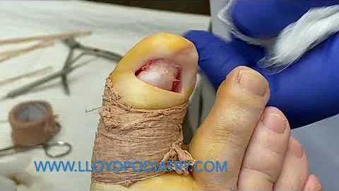 Onychogryphosis: Ram's Horn Nail Removal by Dr. La...