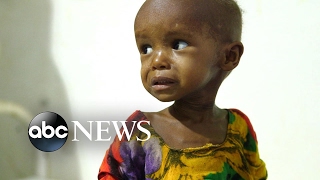 Doctors and nurses are working tirelessly to save children on the
brink of death from starvation.