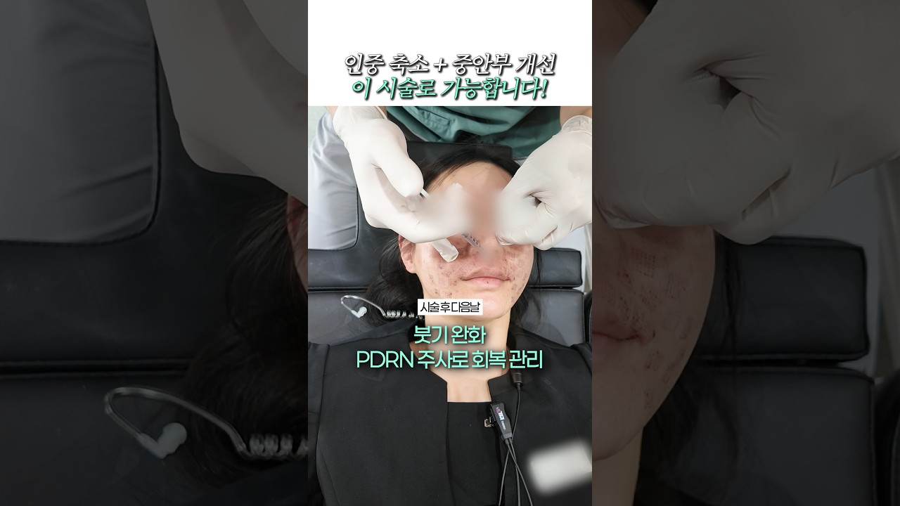 🚨 인중 축소 + 중안부 개선? 이 시술의 정체는?