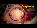 Brain Tumor Resection: Frontal craniotomy and resection of tumor using minimal invasive principles.