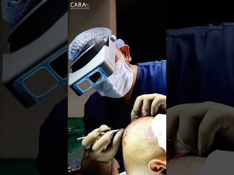 عملية زراعة الشعر باستخدام تقنية السفير 