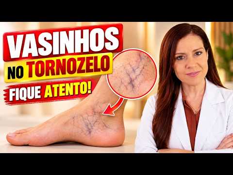 VAZINHOS NO TORNOZELO - Não Ignore este Sinal (Faça ISSO e Veja o que ACONTECE)