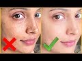 Right Vs Wrong || Hyper-Pigmentation, Dark Spots, Acne Scars || Shruti Arjun Anand