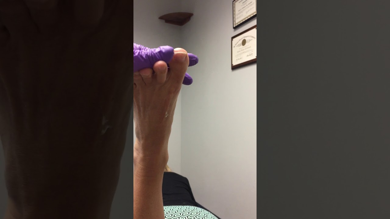 Foot Dysfunction in Chronic Foot Pain and Neuroma Patient upload image
