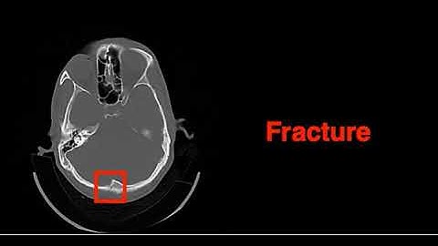Artificial intelligence detects skull fractures