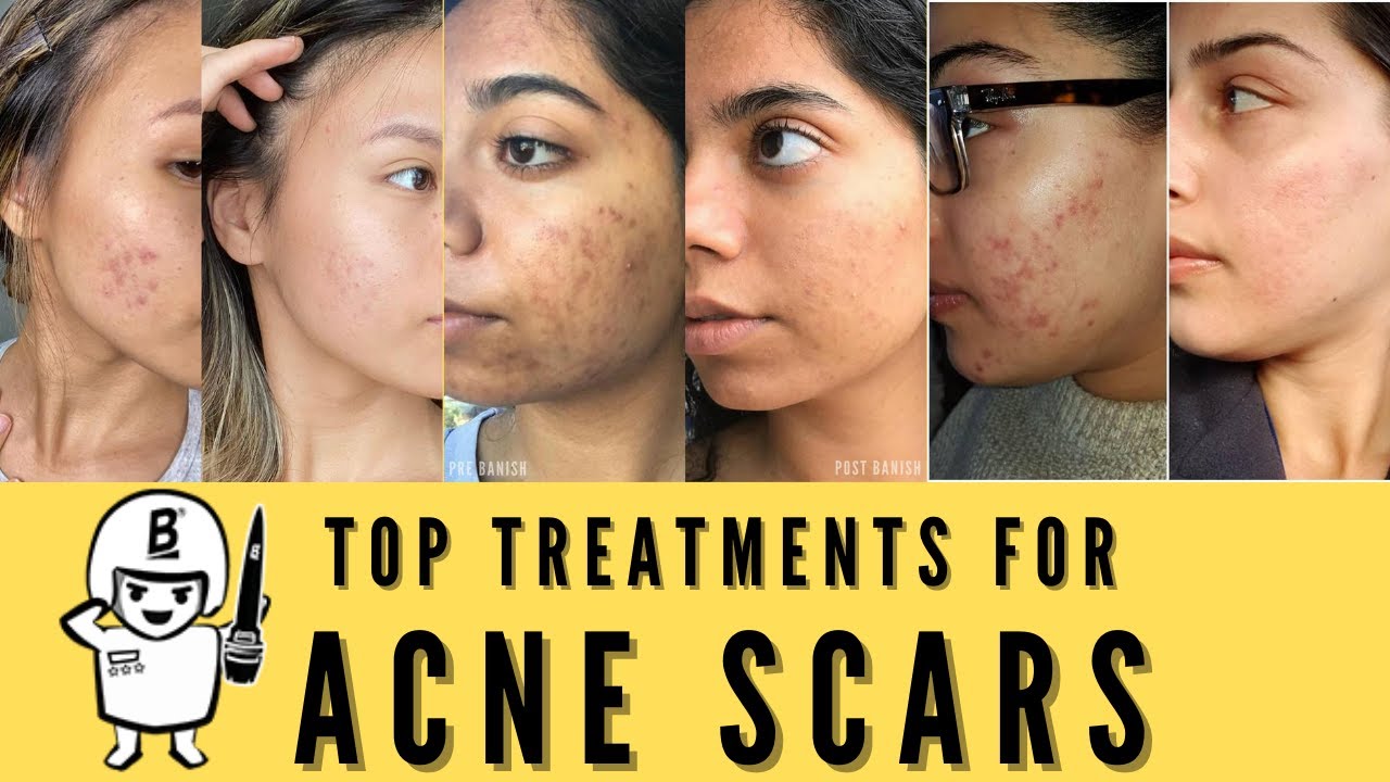 top acne scar treatment