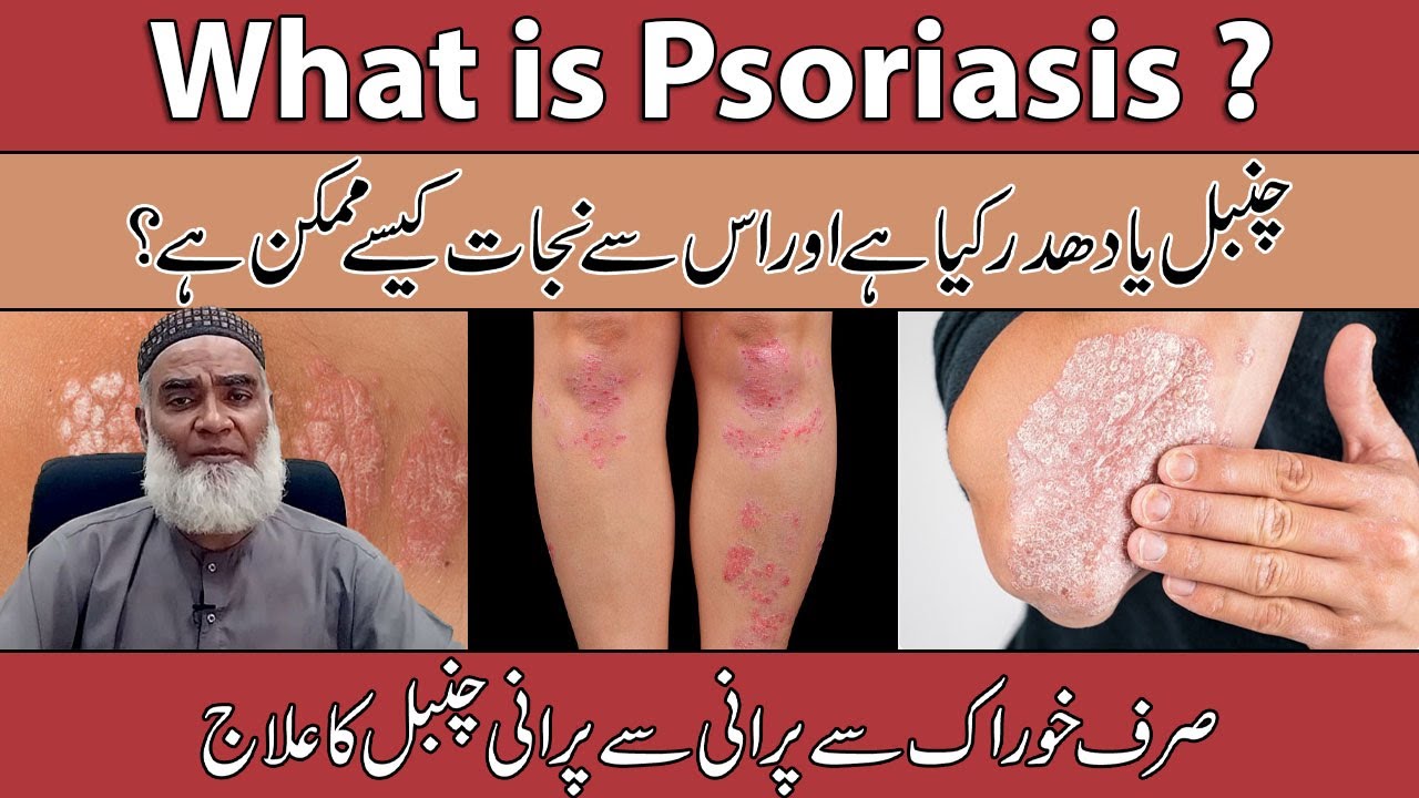 What is Psoriasis (Eczema)? Dhadar, Chambal Aur Kharish Ka Ilaj Al