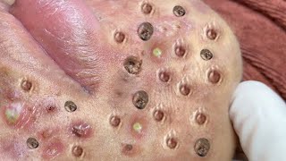 Relax Every Day With Treatment Satisfying blackhead relaxing acne, pimple, cyst by FISHING VIDEO 464 views 1 year ago 5 minutes, 21 seconds