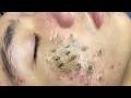 Teen Acne Treatment Journey ❤️ Amazing Results