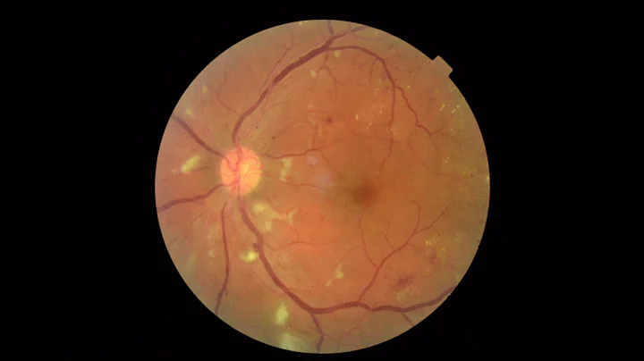 Revolução na Saúde Ocular: IA Detecta Retinopatia Diabética!