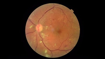 Google AI Experiments - Detecting Diabetic Retinopathy to prevent Blindness | Digit.in