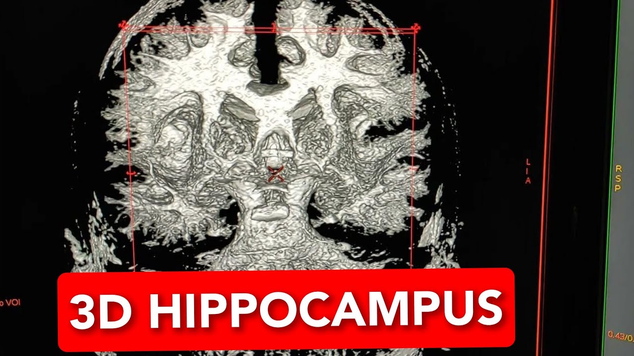 3D Brain For MRI Hippocampus YouTube 3d-brain-for-mri-hippocampus-youtube