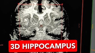 3D Brain for MRI Hippocampus. screenshot 5