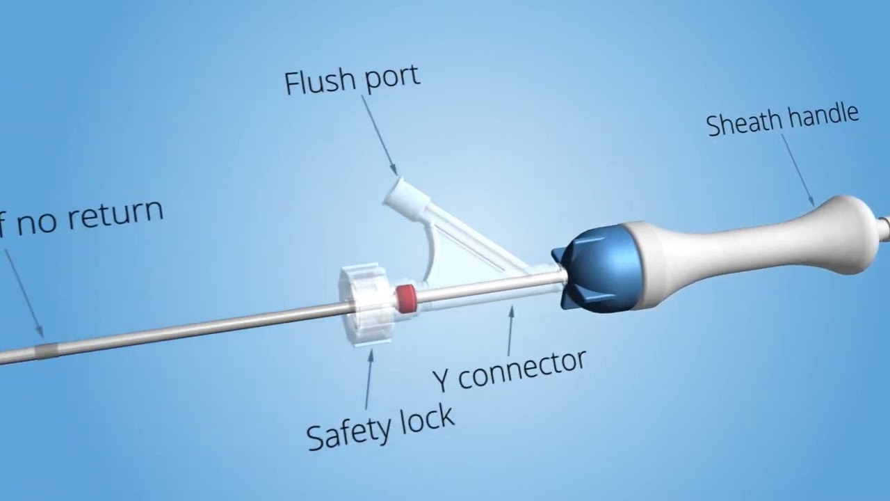 34 DV Stent Loading procedure, 10,5 F