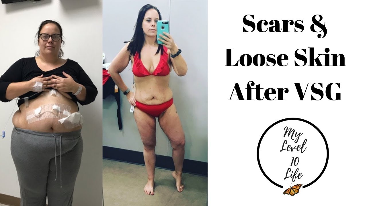 SCARS & LOOSE SKIN AFTER GASTRIC SLEEVE SURGERY ○ I LOST 133