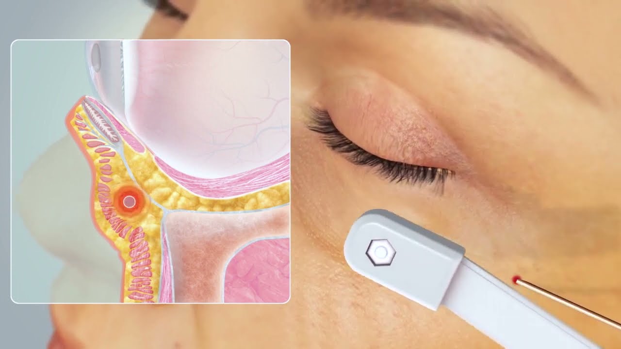 AccuTite Inmode - Clinique Duchesse Anne