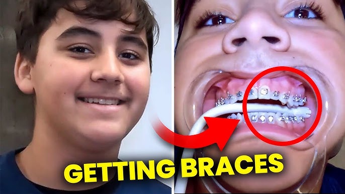 Brace5  Does my child really have to get expanders – or is there a better  way?