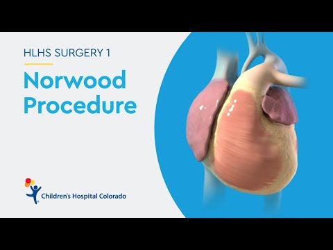 What is the Norwood Procedure for Hypoplastic Left Heart Syndrome