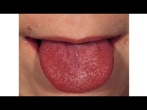 Видео: Разница между скарлатиной и ревматической лихорадкой