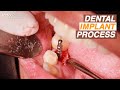 Dental Implant Process