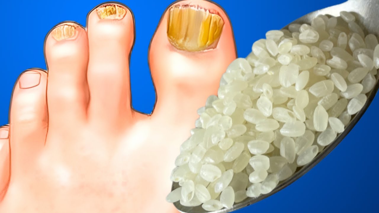 Hochwirksame Nagelpilz-Behandlung – 30 Ml Flüssigkeit Mit Tolnaftat & Undecyensäure, Für Zehen- & Fingernägel