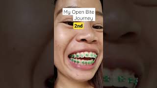 Famous Still on progress. Elastic bands really help. ๐ #BraceJourney #Openbite #braces Net Worth
