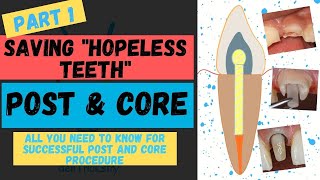 POST AND CORE (Saving 'HOPELESS' Teeth)- Part 1/ Factors for a successful post and core procedure .