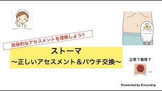 ストーマ管理｜正しいアセスメントとパウチ交換方法