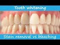 Defining teeth whitening - stain removal vs bleaching