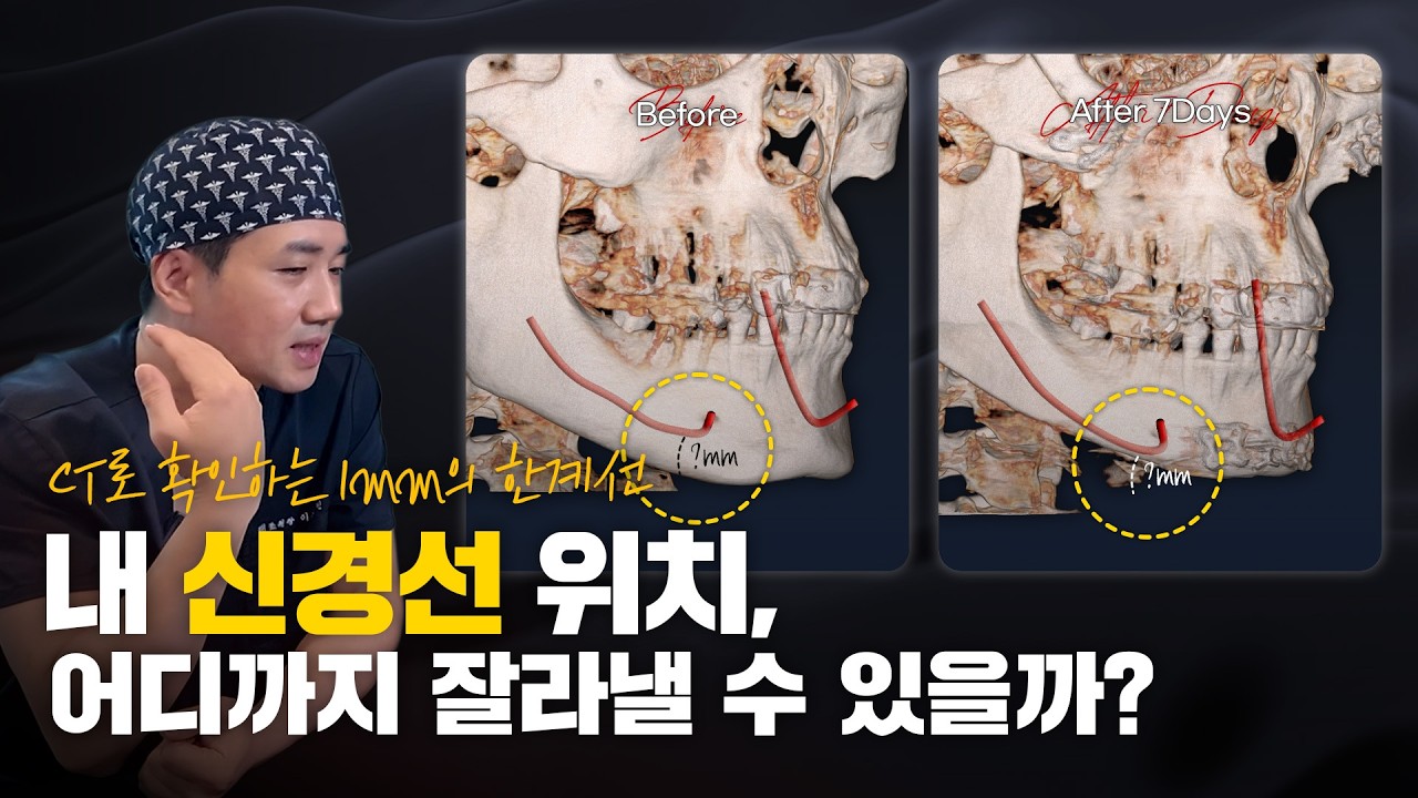 "의사가 편하려고 안 잘라줍니까?" 신경선 바짝 잘라내는 진짜 이유 [윤곽수술]