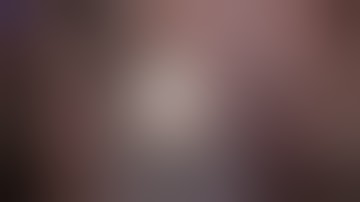 Glaukos iStent Inject W(New Procedure)