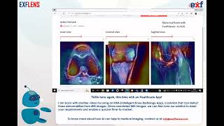 Detect Knee Abnormalities with IKRA – An Intelligent Knee Radiology App by Exafluence