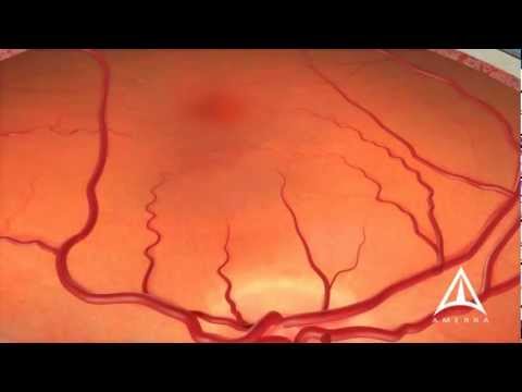 Dry Macular Degeneration