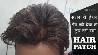 Skin Visibility Undetectable Skin toned Hair patches Delhi by Planet of Hair Cloning Call 9899746489