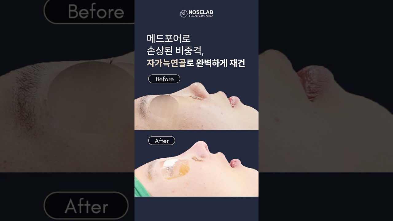 3년 전 코성형 후 메드포어 결과는? 손상된 비중격 재건과 코재수술 핵심 정리