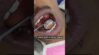 Paan/Gutkha Stains Clean | Dental Scaling Magic 😱”