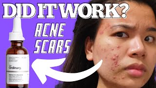 1 Month Of Retinol 1% In Squalene On Acne Scars Review Results The Ordinary Retinol For Acne Skin