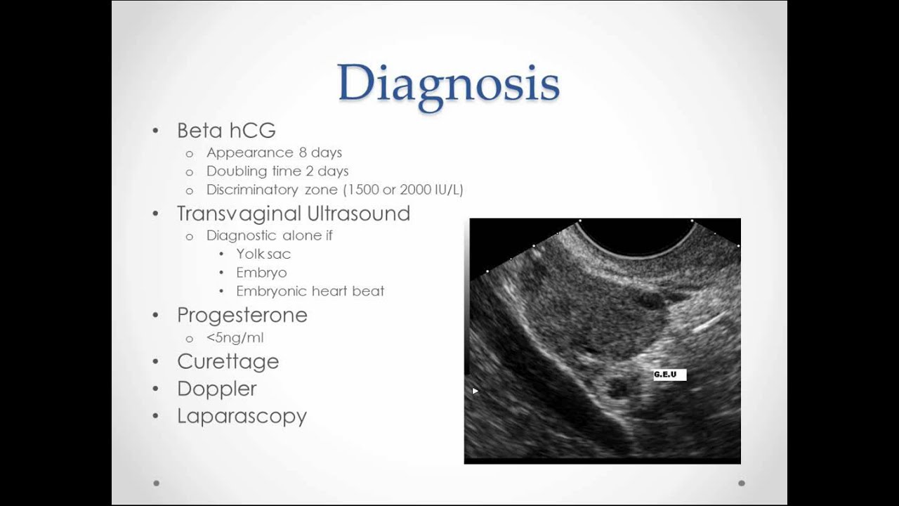 Ectopic Pregnancy USMLE Step 2 Review YouTube