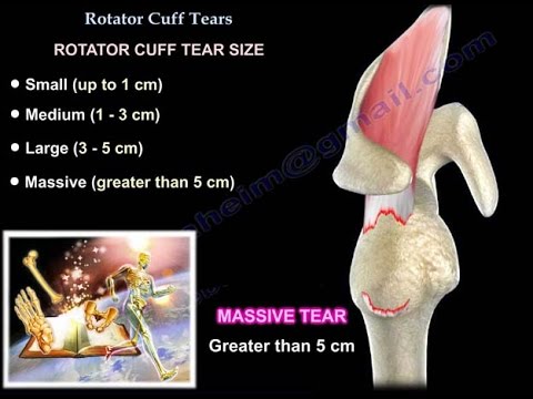 Rotator Cuff Tear ,injury - Everything You Need To Know - Dr