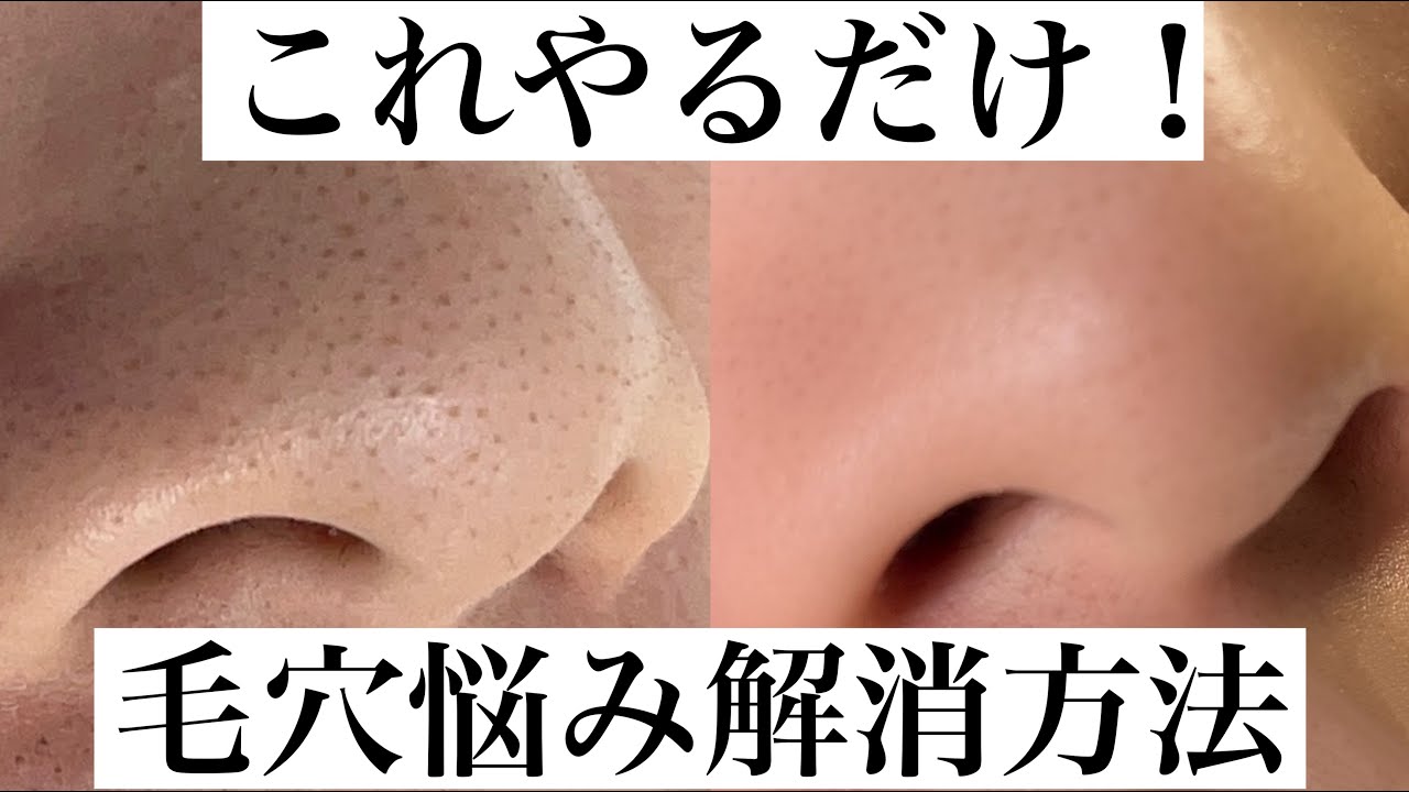毛穴悩み解消！毛穴タイプ別お手入れ方法とアイテム紹介 - YouTube