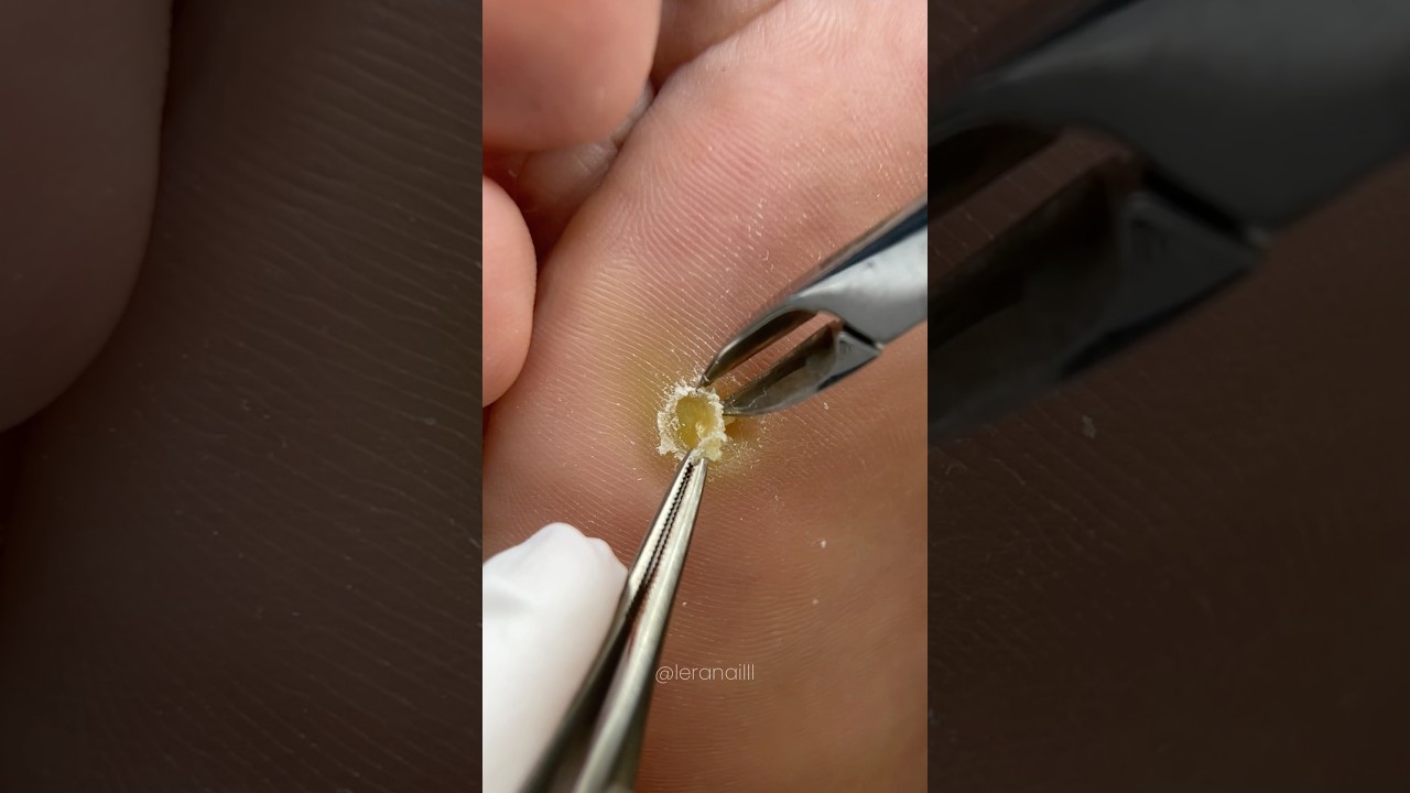 Стержневая мозоль на стопе #podologia #подолог #педикюр #nails #подология #мозоль #pedicure