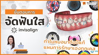 ขั้นตอนการจัดฟันใส invisalign  : ทำไมหมอนาต้องแก้แผนการรักษาเองทุกเคส